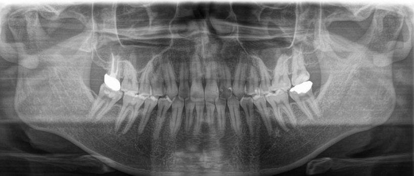 デンタルエックス線写真 港区／新橋駅4分で「お口の総合精密検査／歯科ドック」｜吉樹デンタル