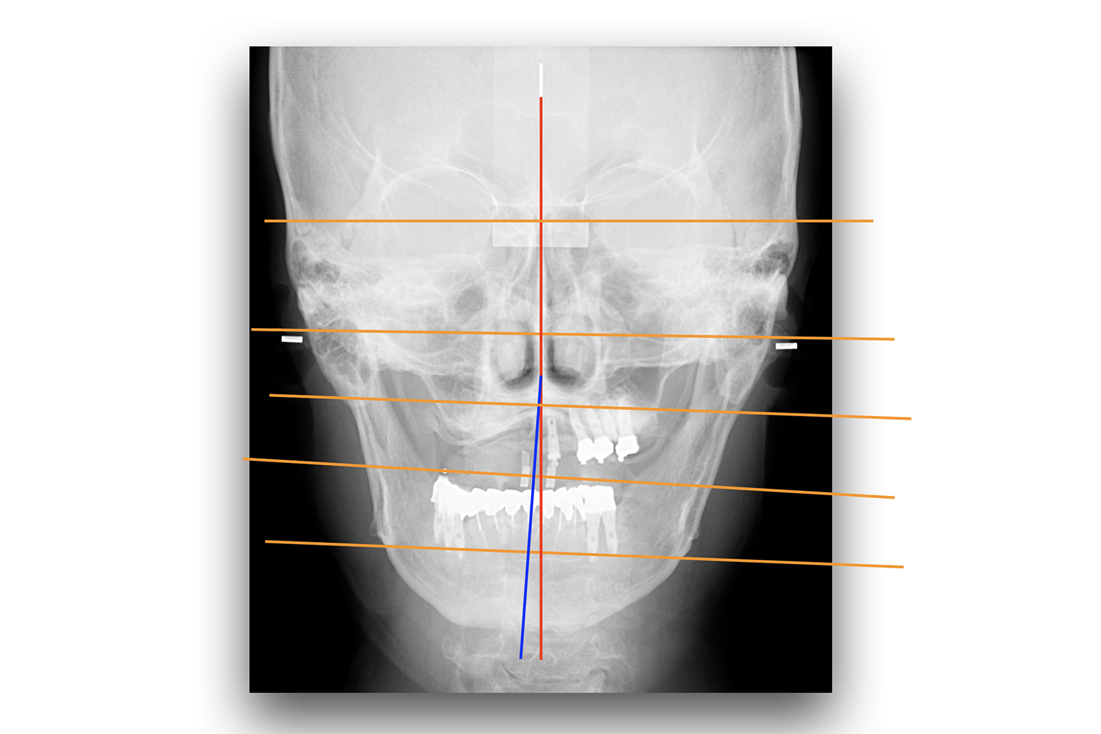 港区／新橋駅4分で「お口の総合精密検査／歯科ドック」｜吉樹デンタル